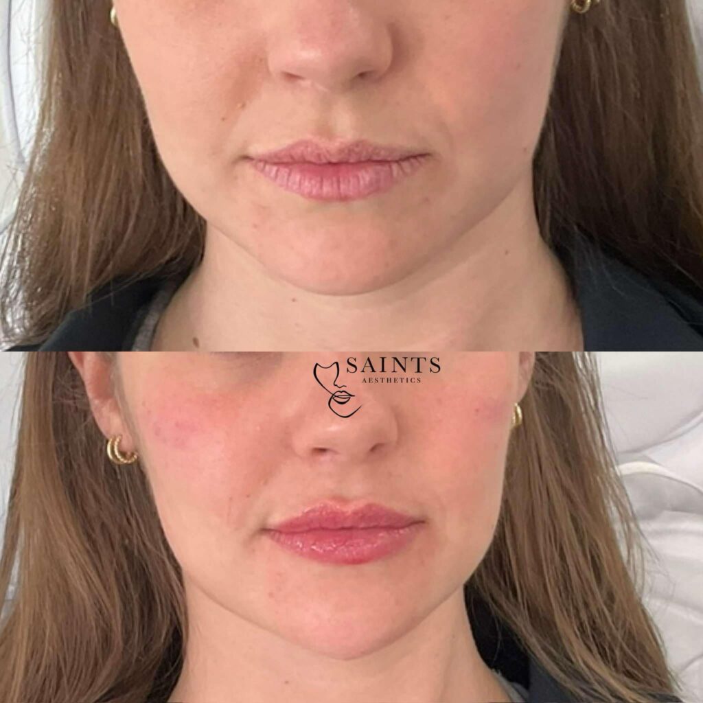Saints Aesthetics Sheffield Lip Filler results