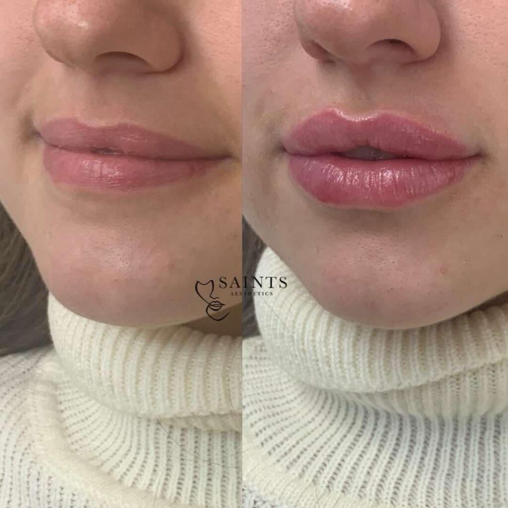 Saints Aesthetics Sheffield Lip Filler results
