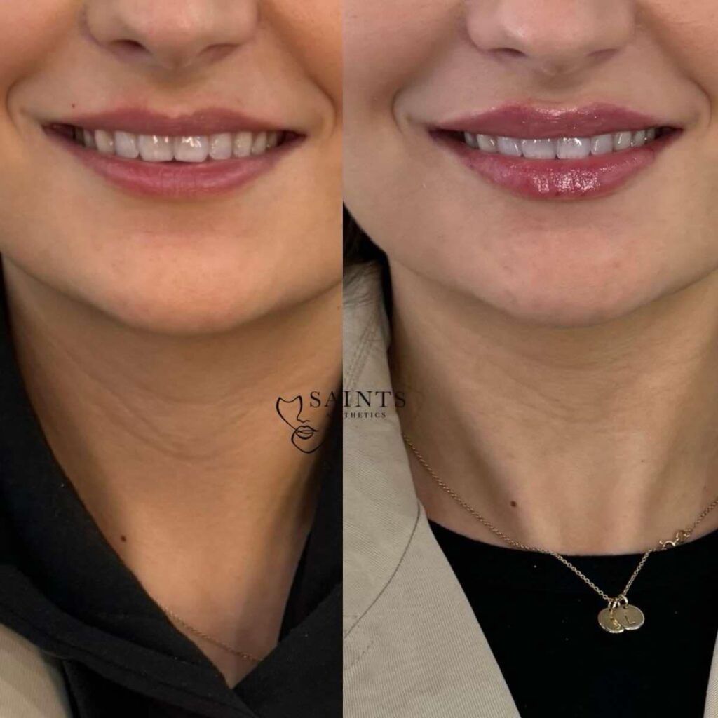 Saints Aesthetics Sheffield Lip Filler results
