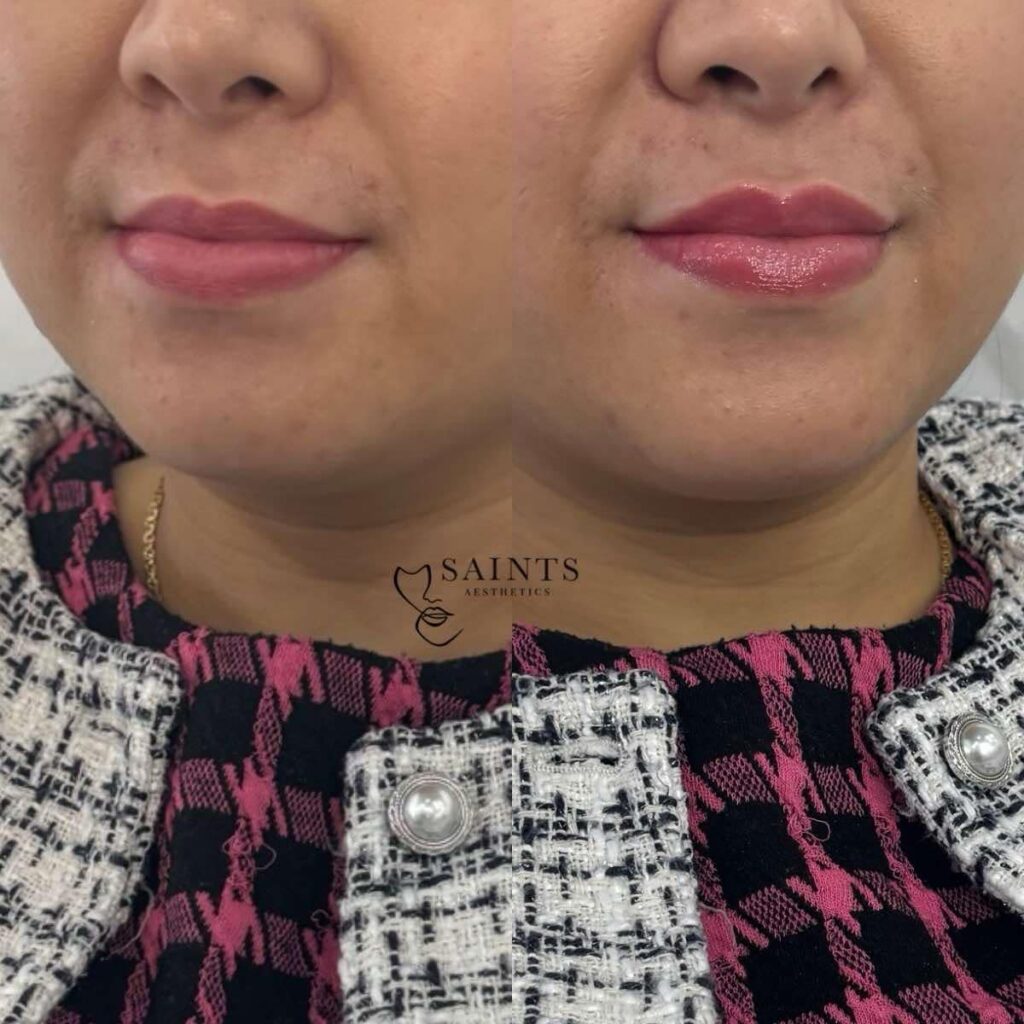Saints Aesthetics Sheffield Lip Filler results