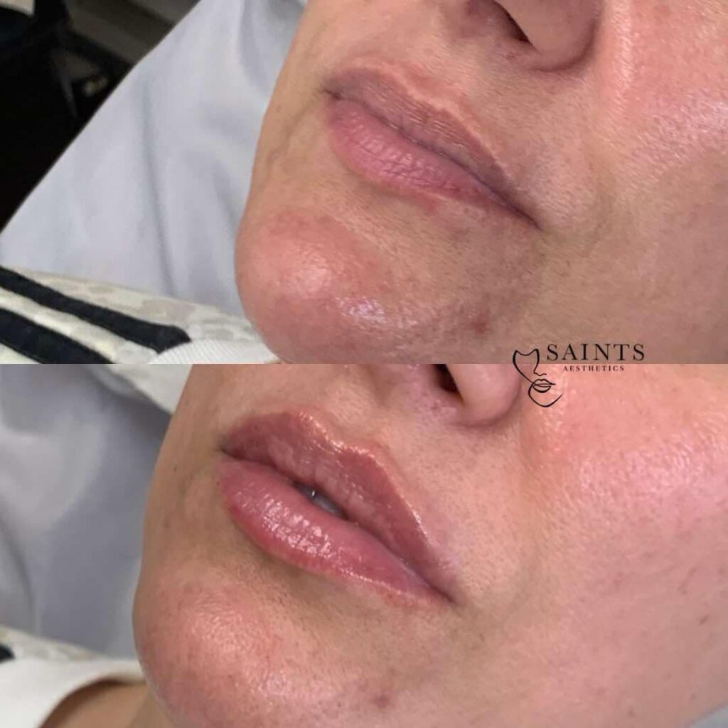 Saints Aesthetics Sheffield Lip Filler results