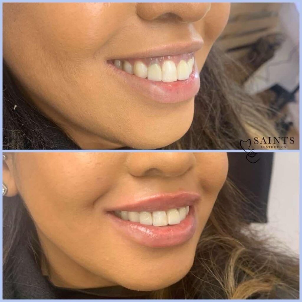 Saints Aesthetics Sheffield Lip Filler results
