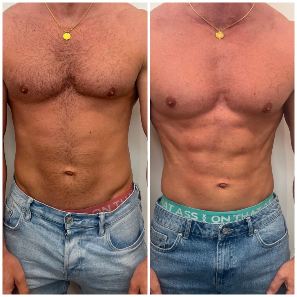 EMS Body Sculpt 2