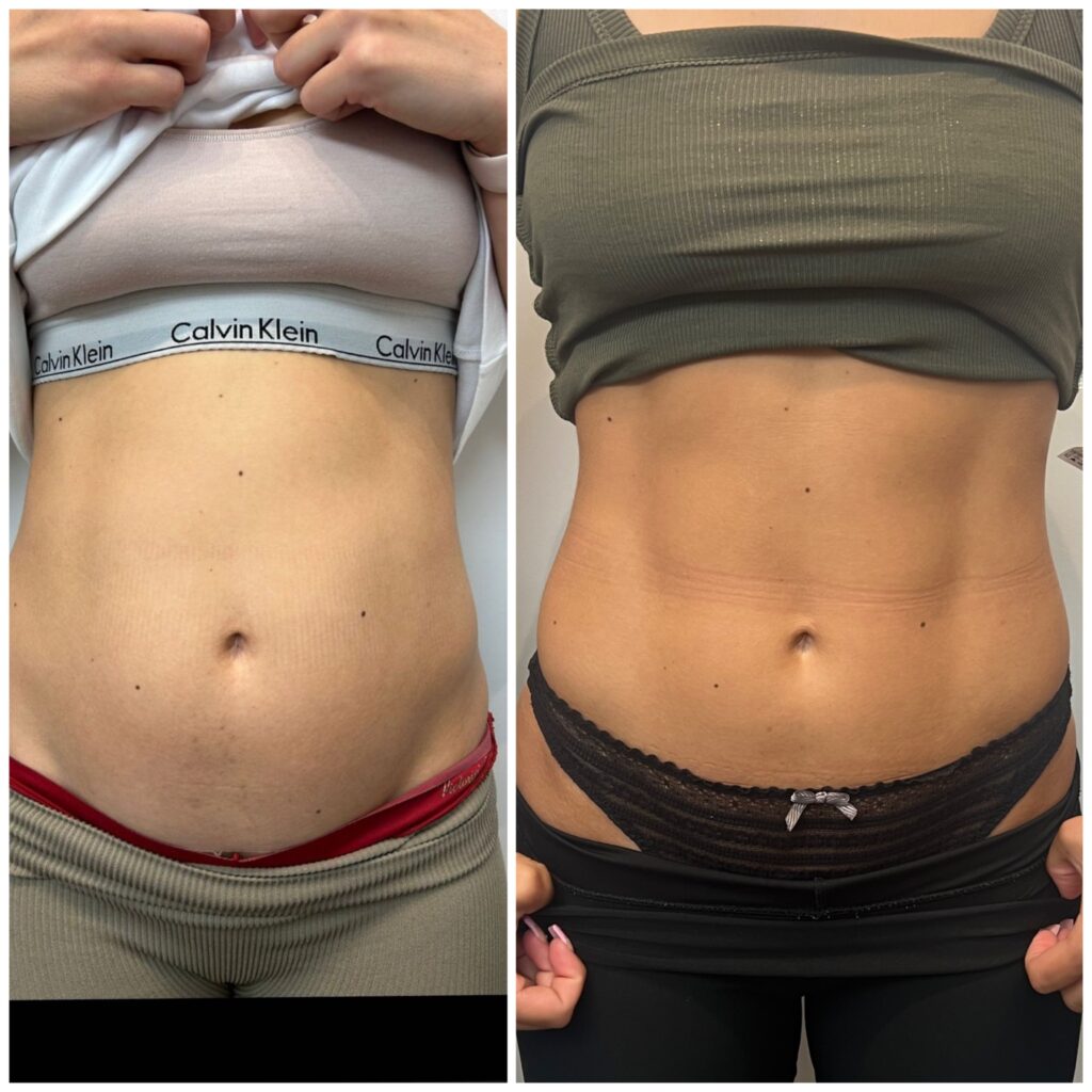 EMS Body Sculpt