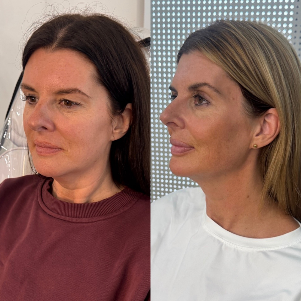 Beige Minimalist Skincare Before and After Instagram Post