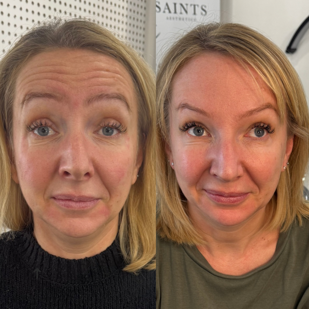 Anti-wrinkle Treatment