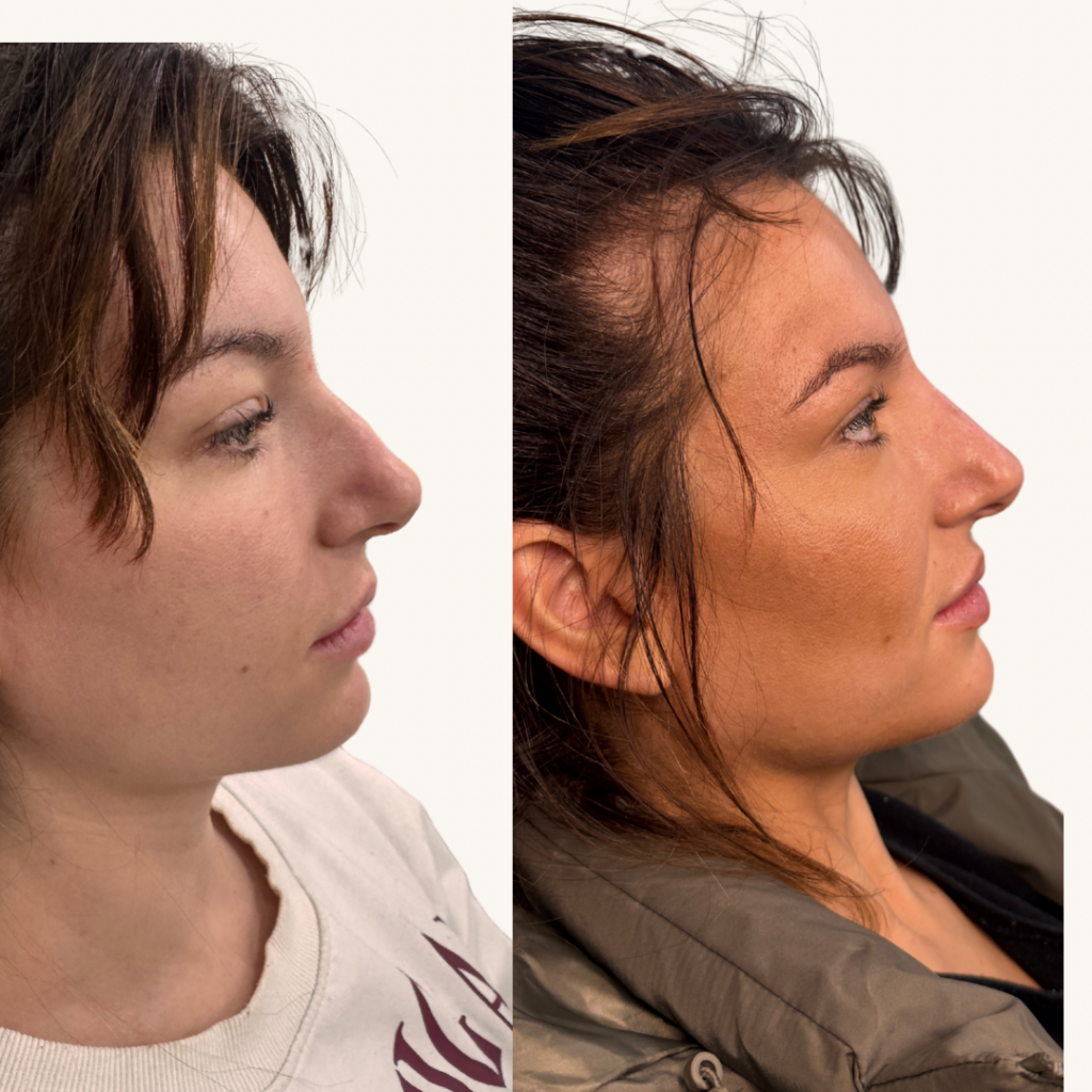Beige Minimalist Skincare Before and After Instagram Post(1)