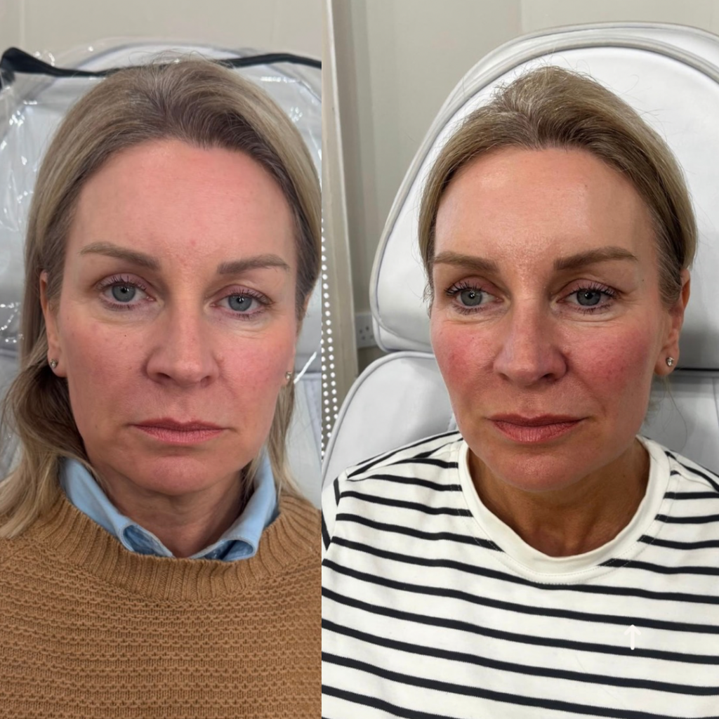Beige Minimalist Skincare Before and After Instagram Post(1)