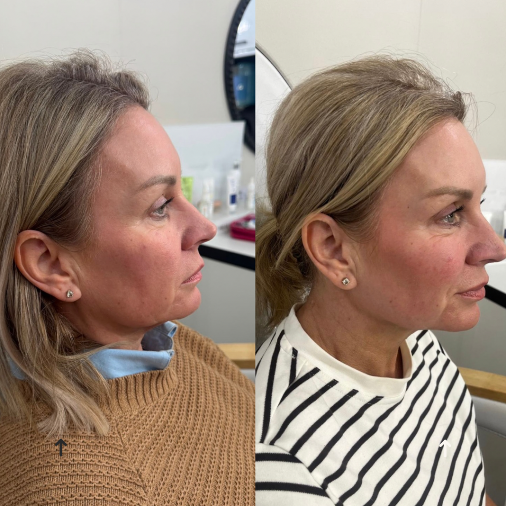 Beige Minimalist Skincare Before and After Instagram Post(2)