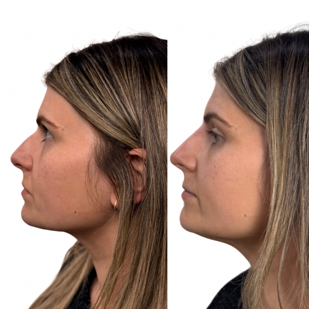 Beige White Minimalist Beauty Skincare Before After Collage Instagram Post