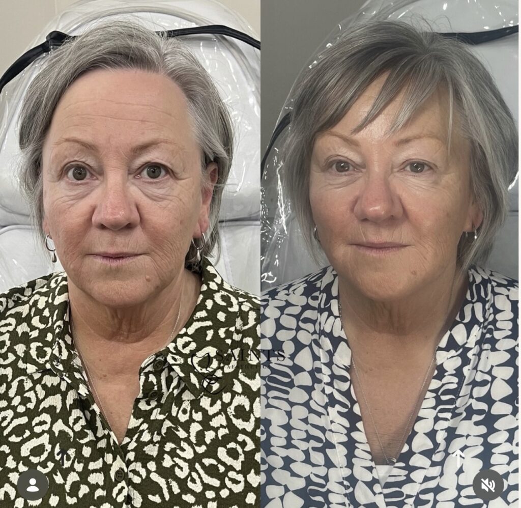 Cheek Enhancement 4