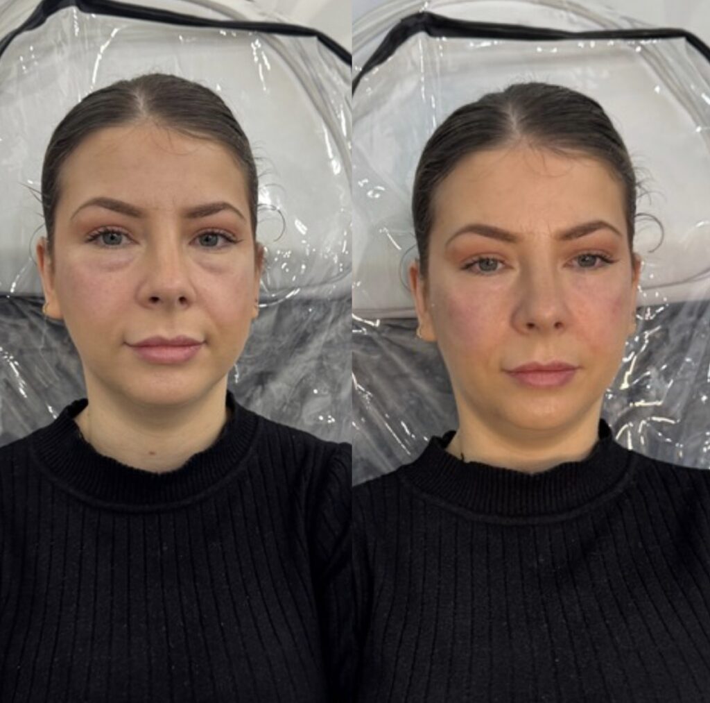 Cheek Enhancement 2