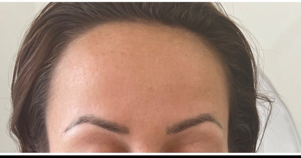 Anti-wrinkle Treatment 2