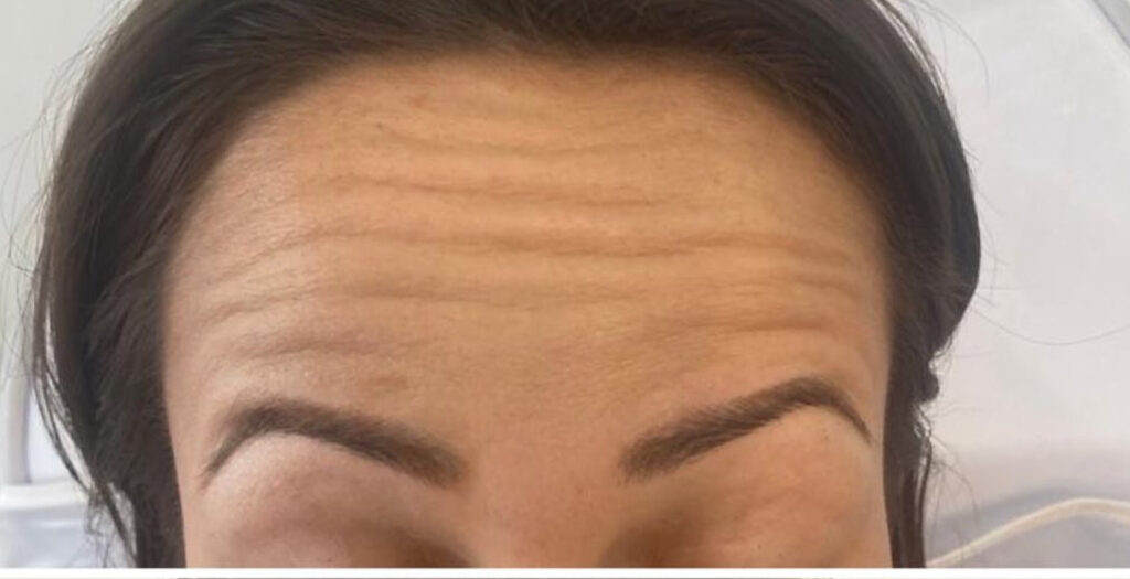 Anti-wrinkle Treatment 3