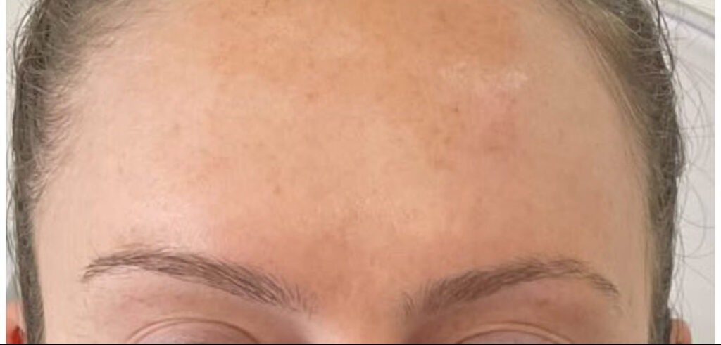 Anti-wrinkle Treatment 4