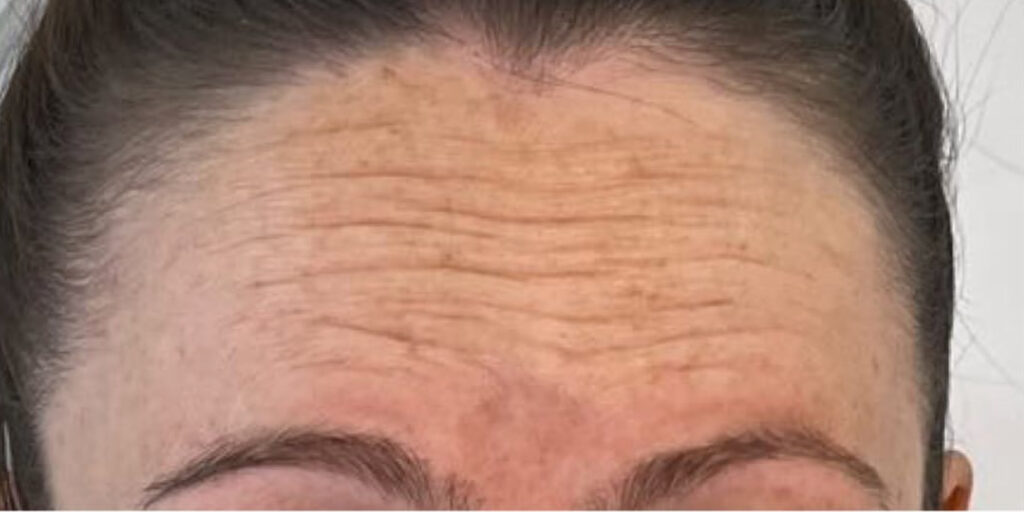 Anti-wrinkle Treatment 5