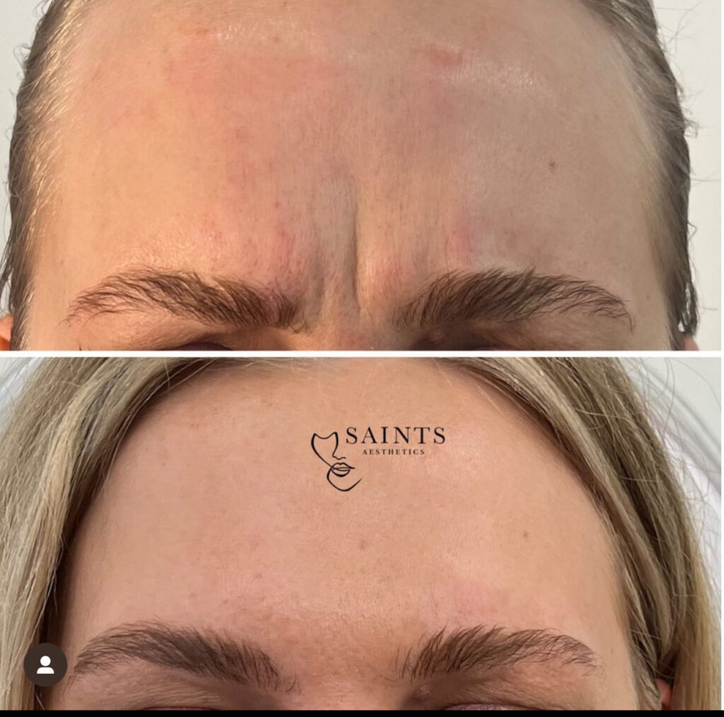 Anti-wrinkle Treatment 6