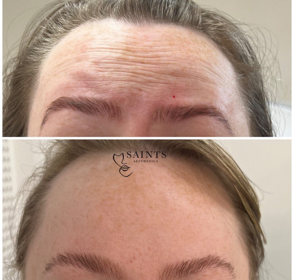 Anti-wrinkle Treatment 7