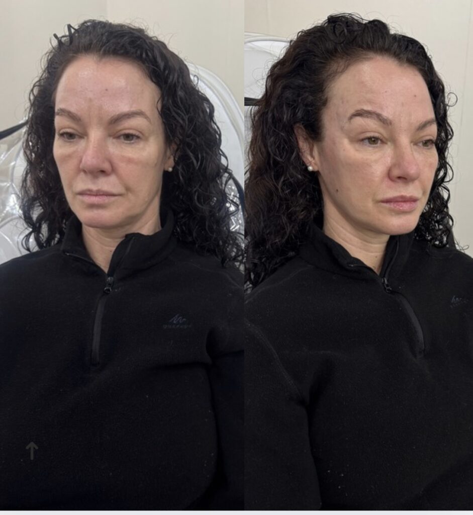 Cheek Enhancement 3