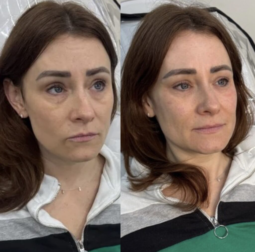 Cheek Enhancement 7