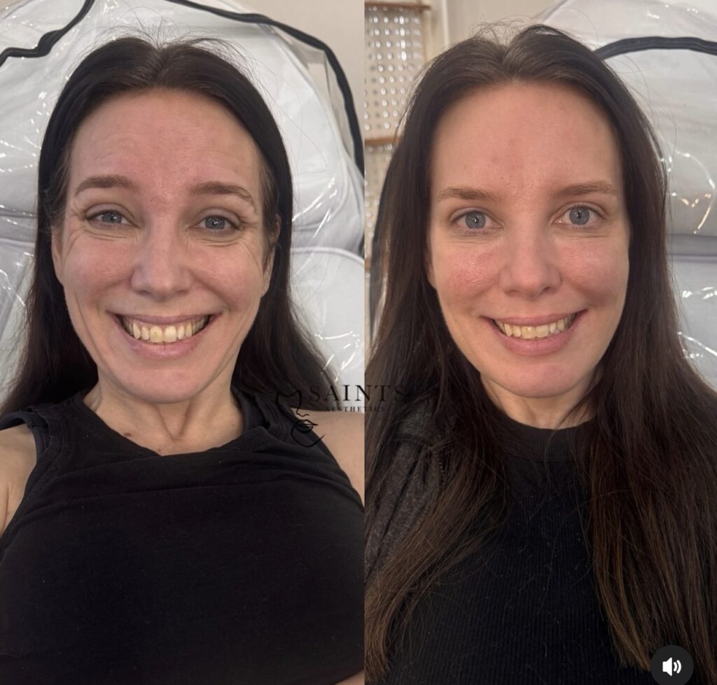 Anti-wrinkle Treatment 8
