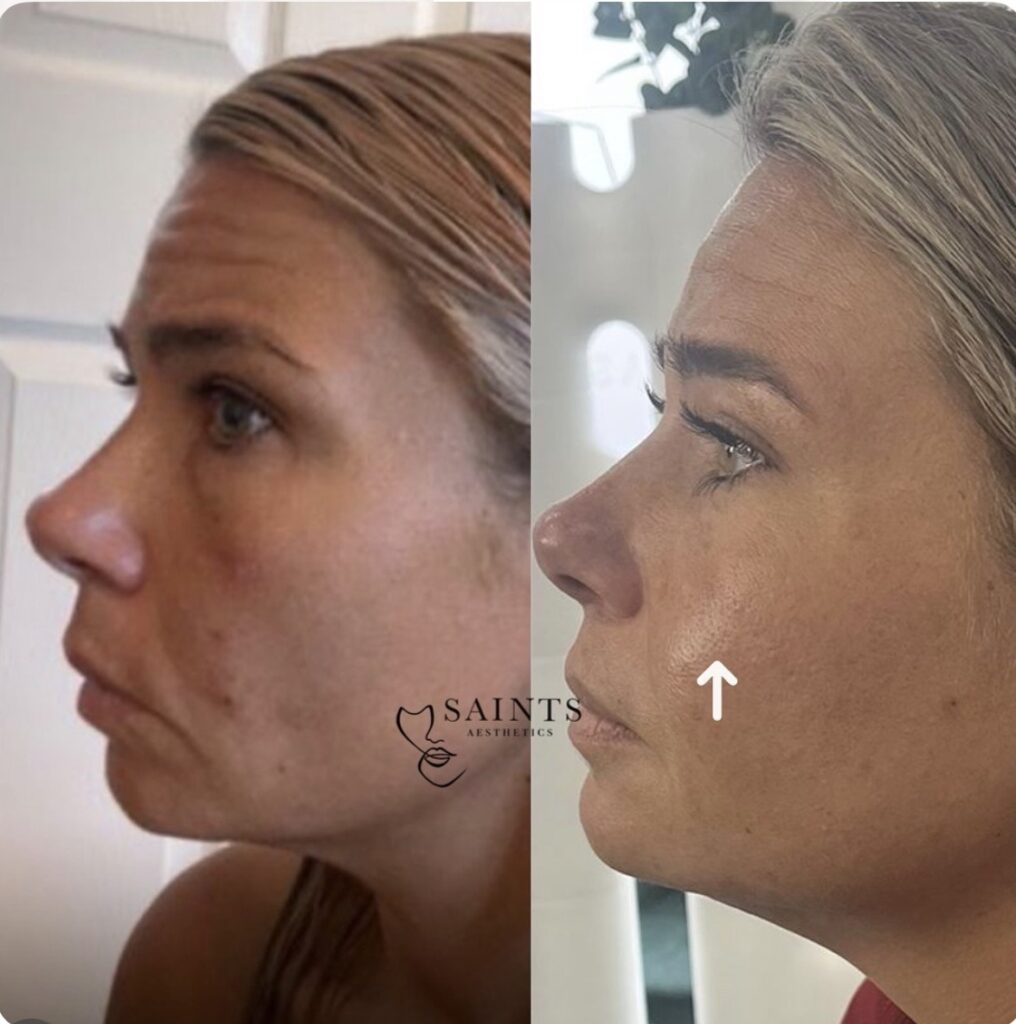 Cheek Enhancement