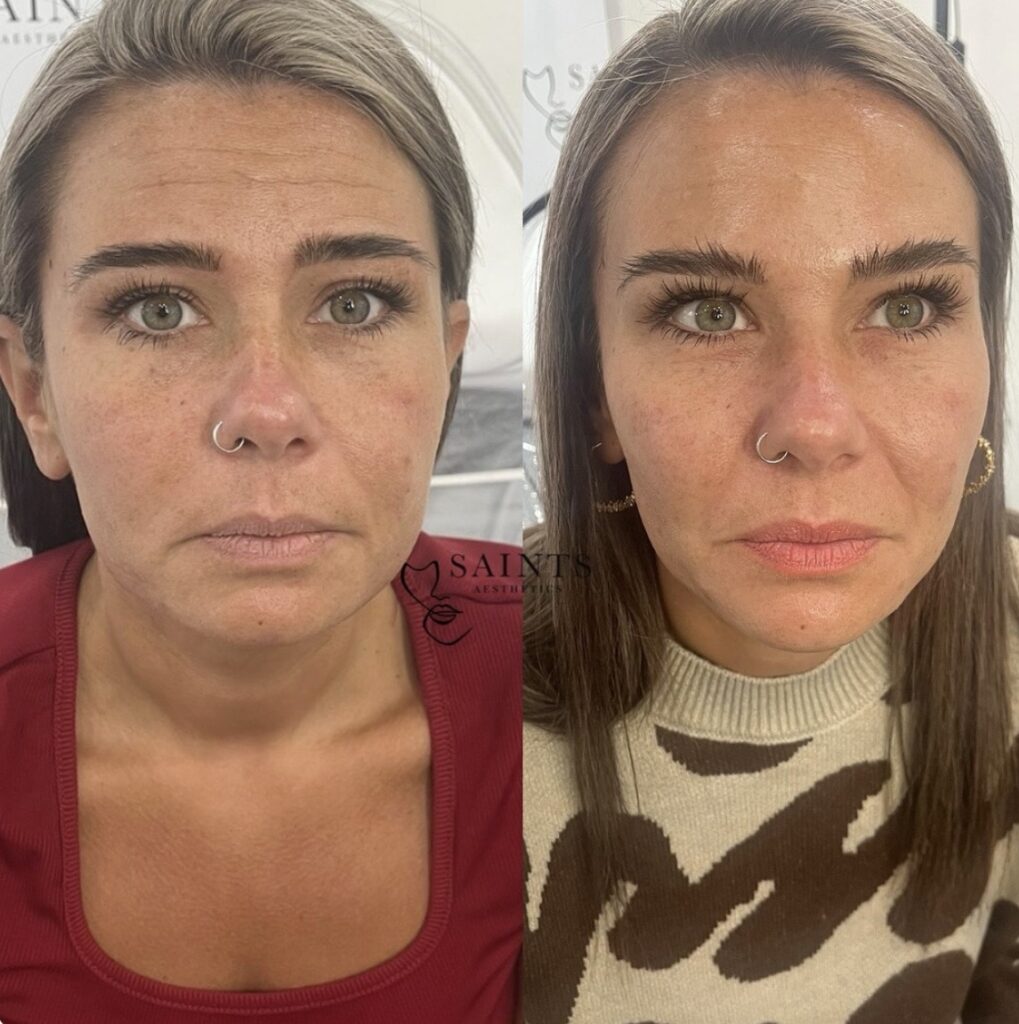 Cheek Enhancement 5